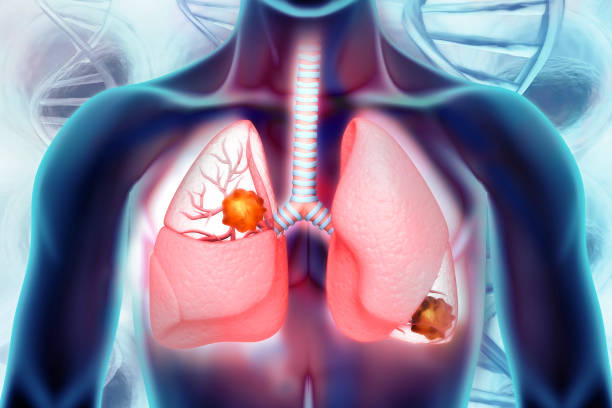 Thuốc lá là nguyên nhân hàng đầu gây ra bệnh ung thư phổi